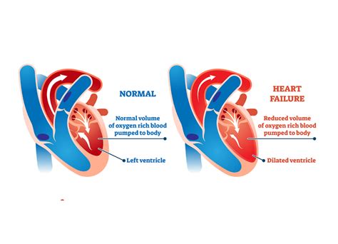 lv failure symptoms|pathophysiology left sided heart failure.